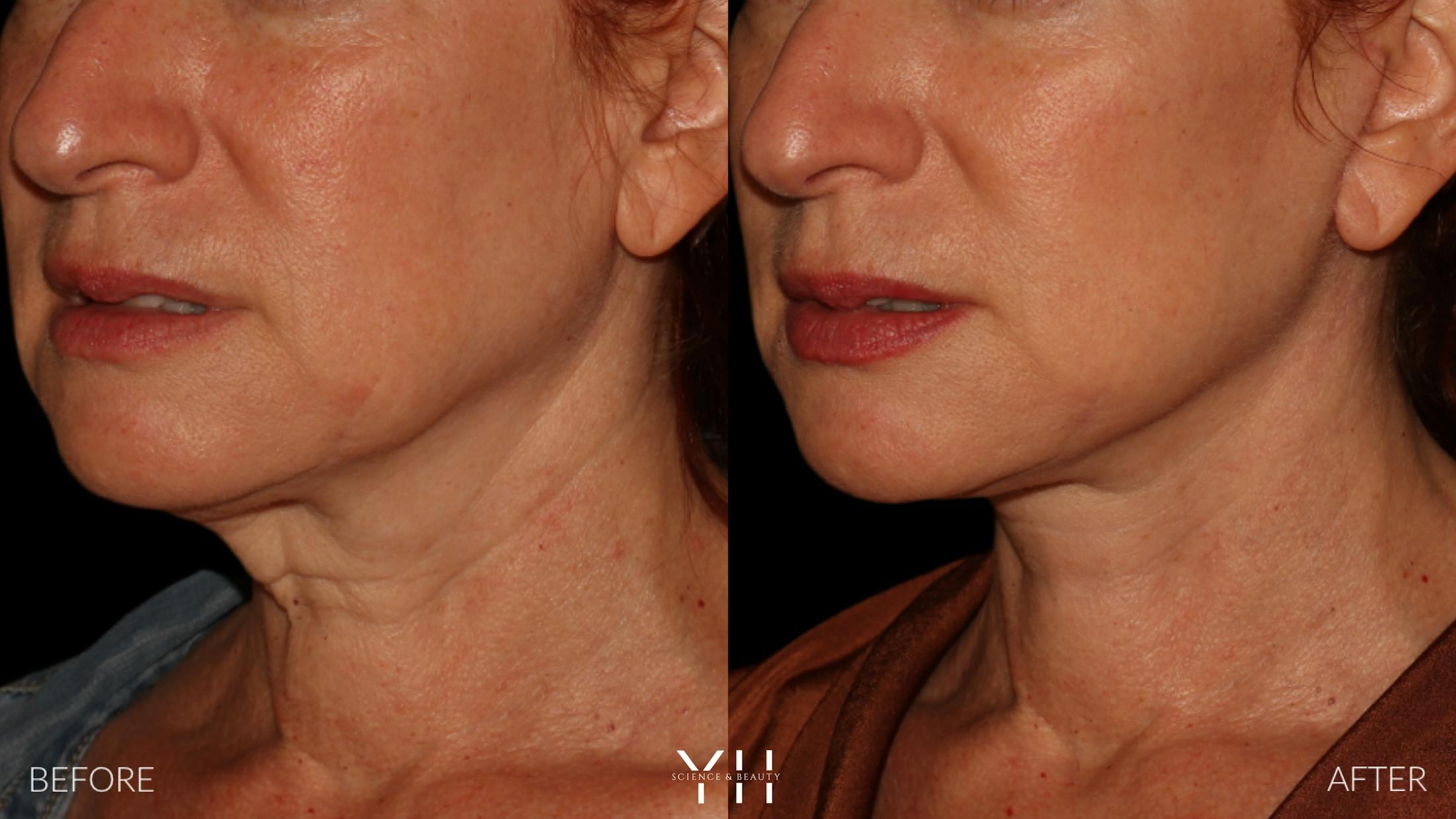 Facelift Before & After Gallery - Patient 100907 - Image 13