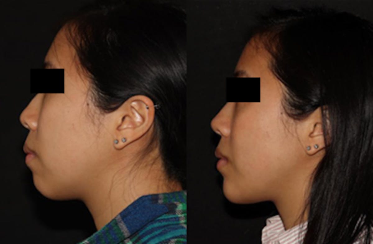 Chin Augmentation Before & After Gallery - Patient 149051072 - Image 1