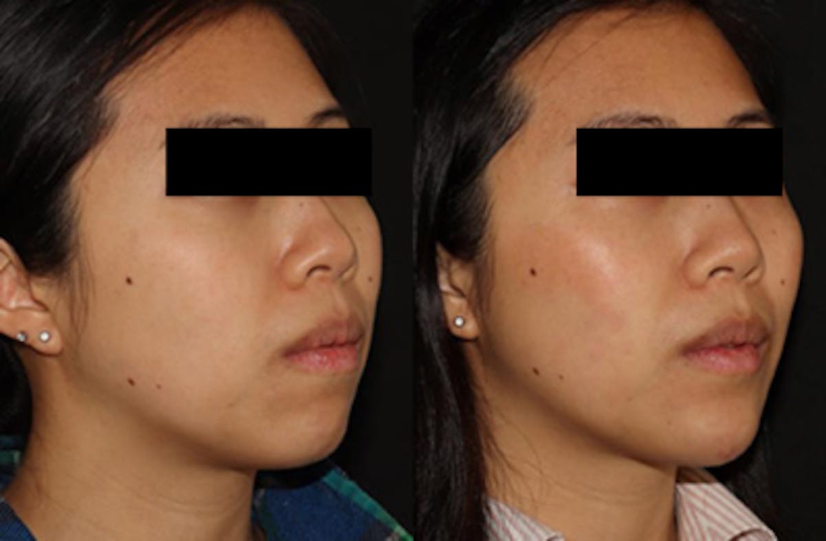 Chin Augmentation Before & After Gallery - Patient 149051072 - Image 2