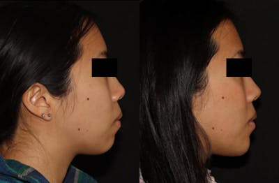 Chin Augmentation Before & After Gallery - Patient 149051072 - Image 3
