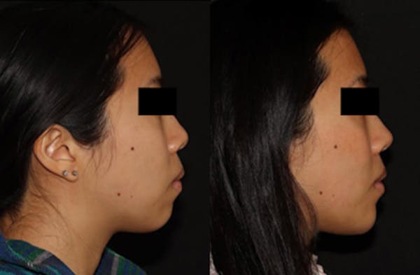 Chin Augmentation Before & After Gallery - Patient 149051072 - Image 3