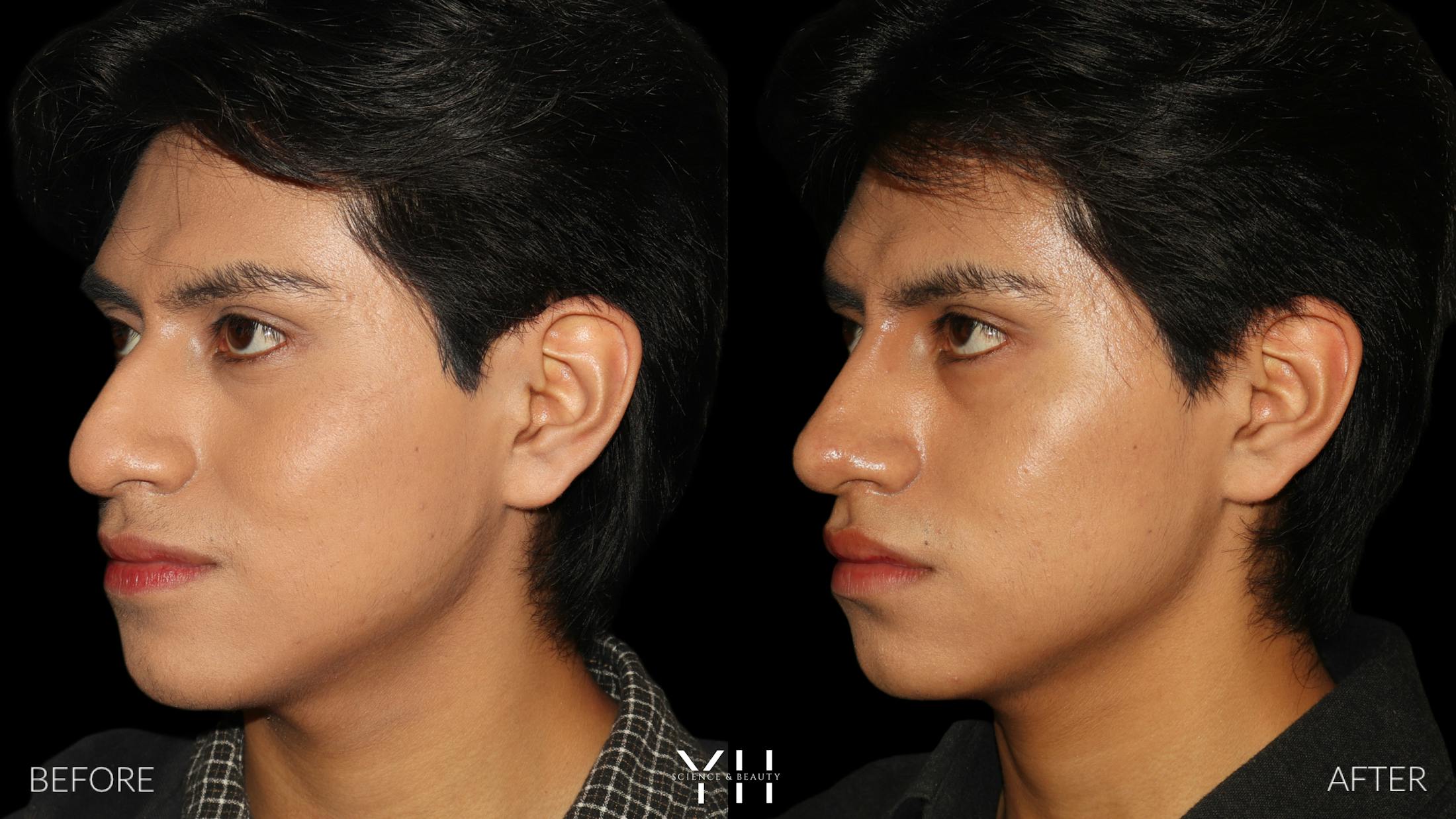 Liquid Rhinoplasty Before & After Gallery - Patient 363686 - Image 6