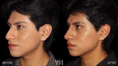 Liquid Rhinoplasty Before & After Gallery - Patient 363686 - Image 6