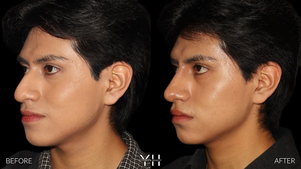 Liquid Rhinoplasty Before & After Gallery - Patient 363686 - Image 6