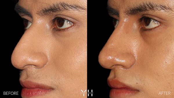 Liquid Rhinoplasty Before & After Gallery - Patient 363686 - Image 3
