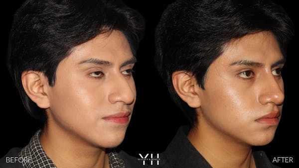 Liquid Rhinoplasty Before & After Gallery - Patient 363686 - Image 5