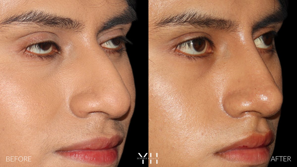 Liquid Rhinoplasty Before & After Gallery - Patient 363686 - Image 2