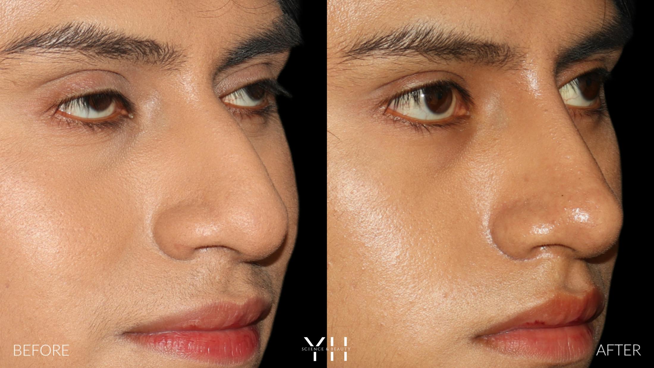 Liquid Rhinoplasty Before & After Gallery - Patient 363686 - Image 2