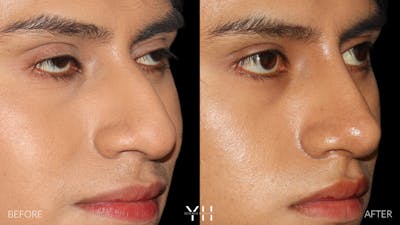 Liquid Rhinoplasty Before & After Gallery - Patient 363686 - Image 2