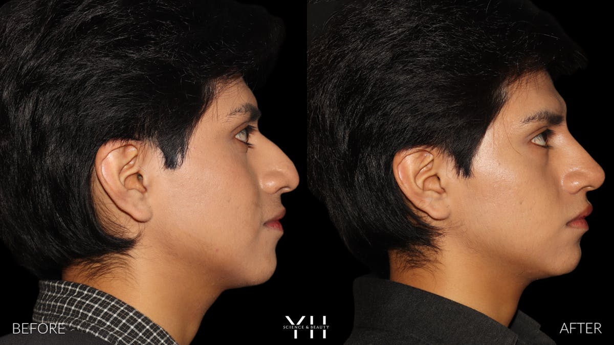 Liquid Rhinoplasty Before & After Gallery - Patient 363686 - Image 4