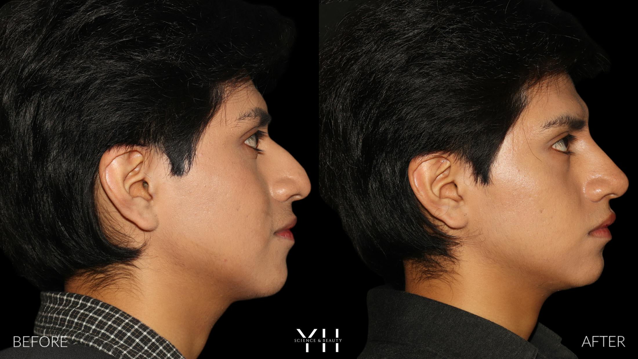 Liquid Rhinoplasty Before & After Gallery - Patient 363686 - Image 4