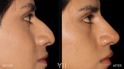 Liquid Rhinoplasty Before & After Gallery - Patient 363686 - Image 1