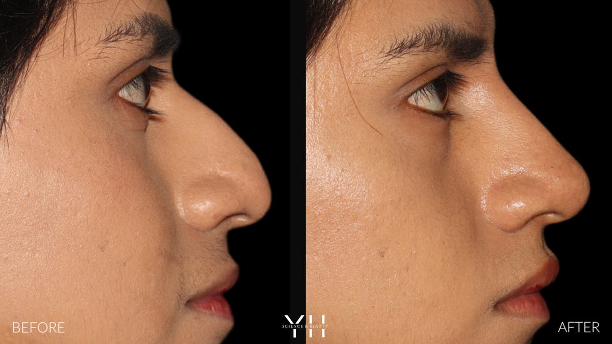 Liquid Rhinoplasty Before & After Gallery - Patient 363686 - Image 1
