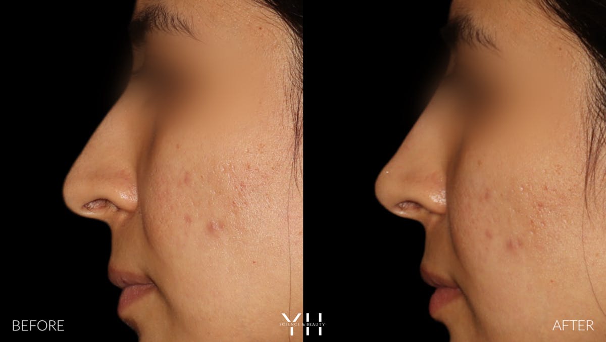 Liquid Rhinoplasty Before & After Gallery - Patient 280161 - Image 1