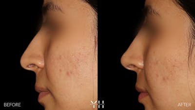 Liquid Rhinoplasty Before & After Gallery - Patient 280161 - Image 1
