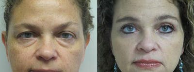  Blepharoplasty Before & After Gallery - Patient 25274627 - Image 1