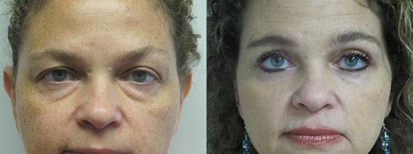  Blepharoplasty Before & After Gallery - Patient 25274627 - Image 1