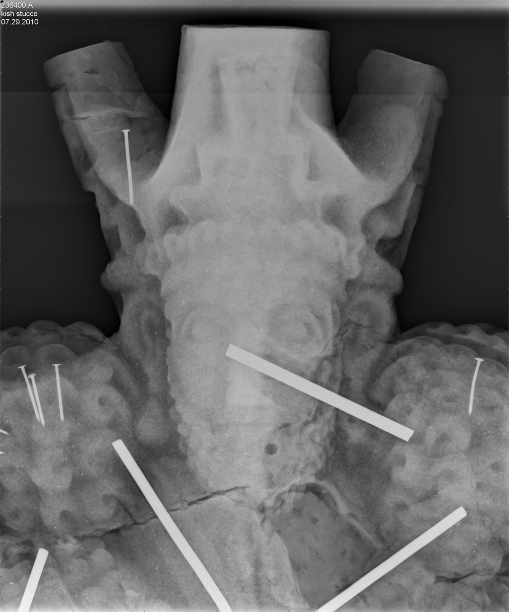 Stucco bust, Iraq, c.5th CE: The X-ray image shows metal nails and bars used to attach fill materials in an early restoration attempt.  If relative humidity is not carefully controlled, the metal could corrode and damage the original stucco.  Less attenuating (grayer) material at left of image is a plaster of Paris restoration fill.