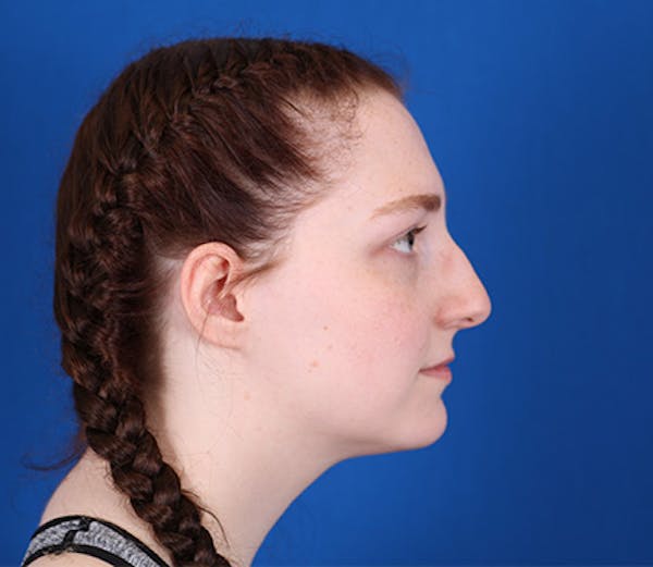 Rhinoplasty Before & After Gallery - Patient 24798207 - Image 1