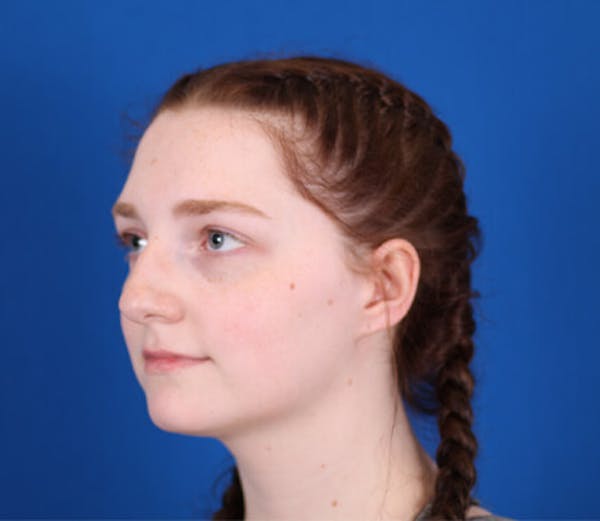 Rhinoplasty Before & After Gallery - Patient 24798207 - Image 3