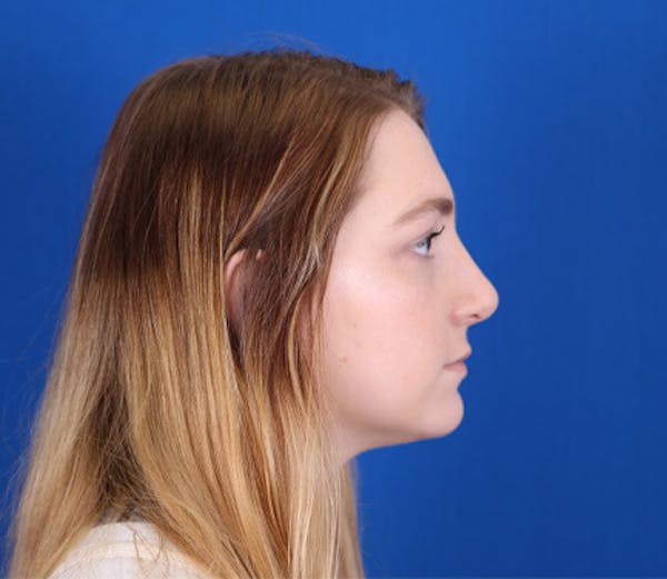 Rhinoplasty Before & After Gallery - Patient 24798207 - Image 2