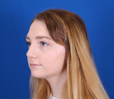 Rhinoplasty Before & After Gallery - Patient 24798207 - Image 4