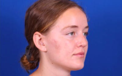 Rhinoplasty Before & After Gallery - Patient 24798208 - Image 4