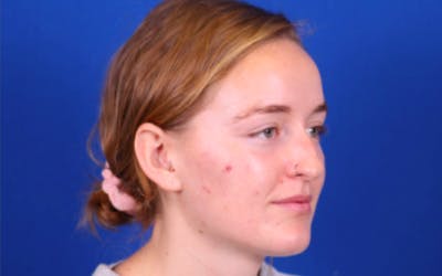 Rhinoplasty Before & After Gallery - Patient 24798208 - Image 1