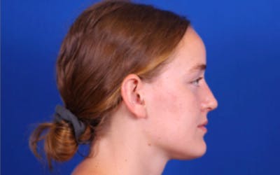 Rhinoplasty Before & After Gallery - Patient 24798208 - Image 2