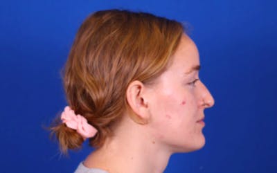 Rhinoplasty Before & After Gallery - Patient 24798208 - Image 1