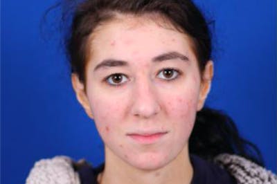 Rhinoplasty Before & After Gallery - Patient 24798209 - Image 1