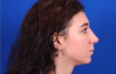 Rhinoplasty Before & After Gallery - Patient 24798209 - Image 2