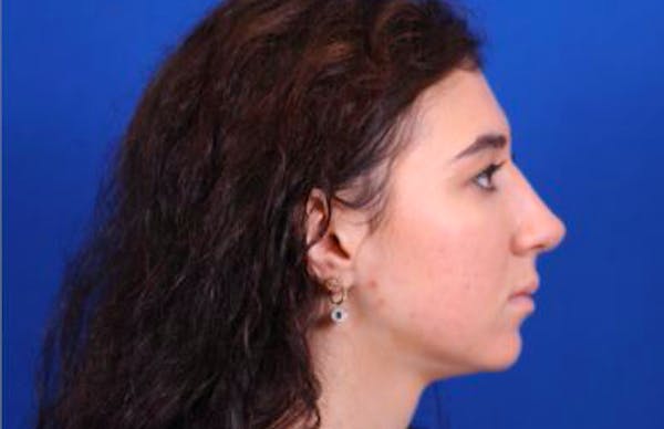 Rhinoplasty Before & After Gallery - Patient 24798209 - Image 2
