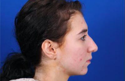 Rhinoplasty Before & After Gallery - Patient 24798209 - Image 1
