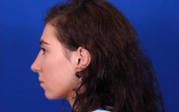 Rhinoplasty Before & After Gallery - Patient 24798209 - Image 8