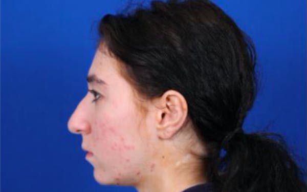 Rhinoplasty Before & After Gallery - Patient 24798209 - Image 7