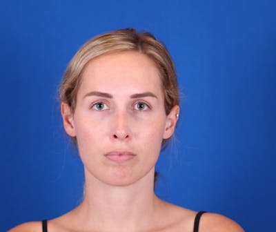 Rhinoplasty Before & After Gallery - Patient 24798210 - Image 6