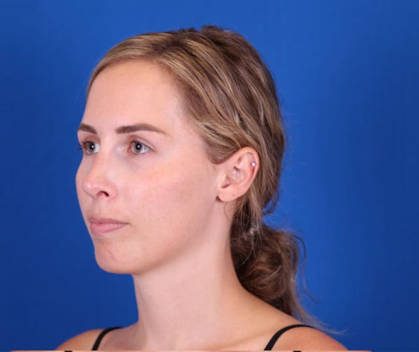 Rhinoplasty Before & After Gallery - Patient 24798210 - Image 4