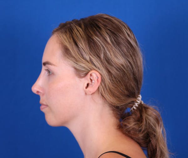 Rhinoplasty Before & After Gallery - Patient 24798210 - Image 2