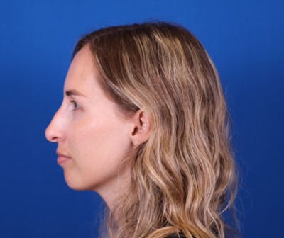 Rhinoplasty Before & After Gallery - Patient 24798210 - Image 1
