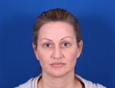 Rhinoplasty Before & After Gallery - Patient 24798341 - Image 1