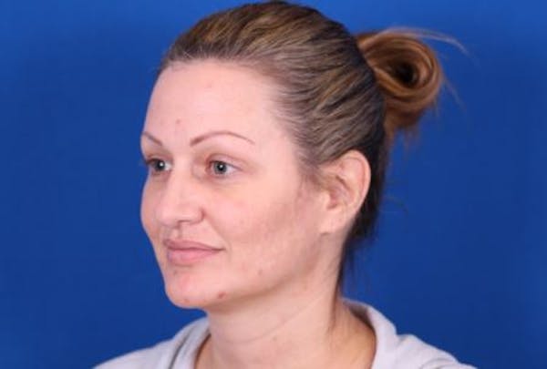 Rhinoplasty Before & After Gallery - Patient 24798341 - Image 3