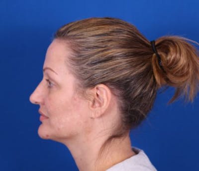 Rhinoplasty Before & After Gallery - Patient 24798341 - Image 1