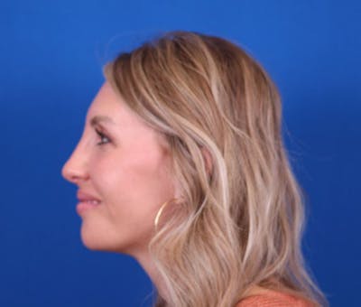 Rhinoplasty Before & After Gallery - Patient 24799486 - Image 2