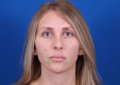 Rhinoplasty Before & After Gallery - Patient 24799486 - Image 1