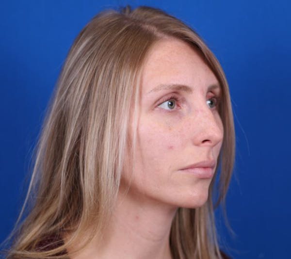 Rhinoplasty Before & After Gallery - Patient 24799486 - Image 3