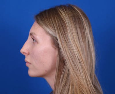 Rhinoplasty Before & After Gallery - Patient 24799486 - Image 1