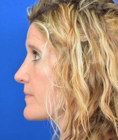 Rhinoplasty Before & After Gallery - Patient 24799487 - Image 2