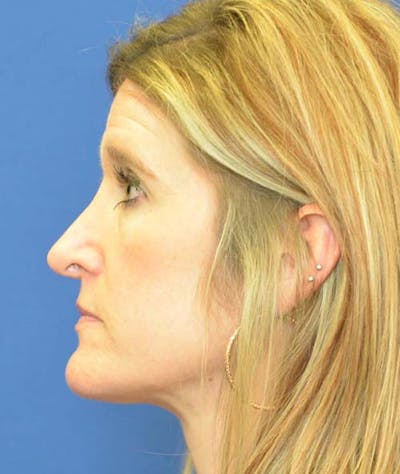Rhinoplasty Before & After Gallery - Patient 24799487 - Image 1