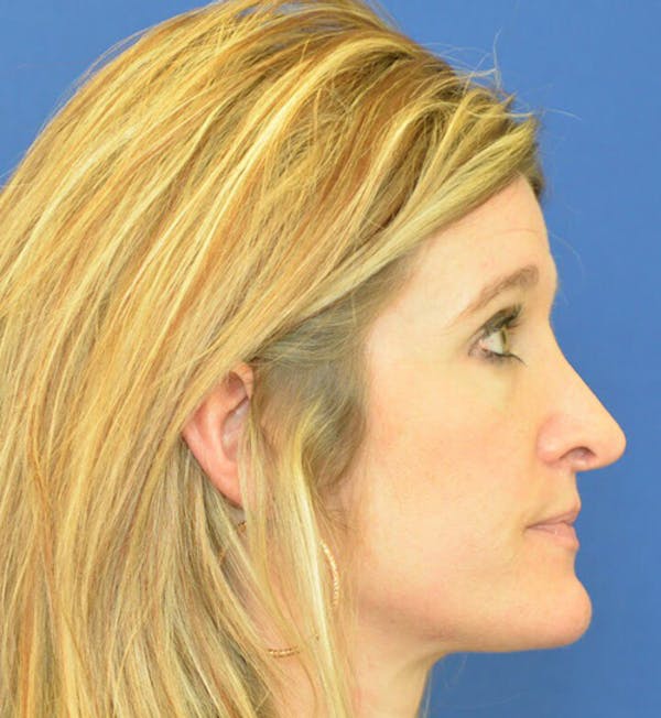 Rhinoplasty Before & After Gallery - Patient 24799487 - Image 3